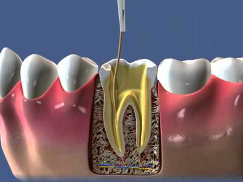 Лечение зубных каналов 